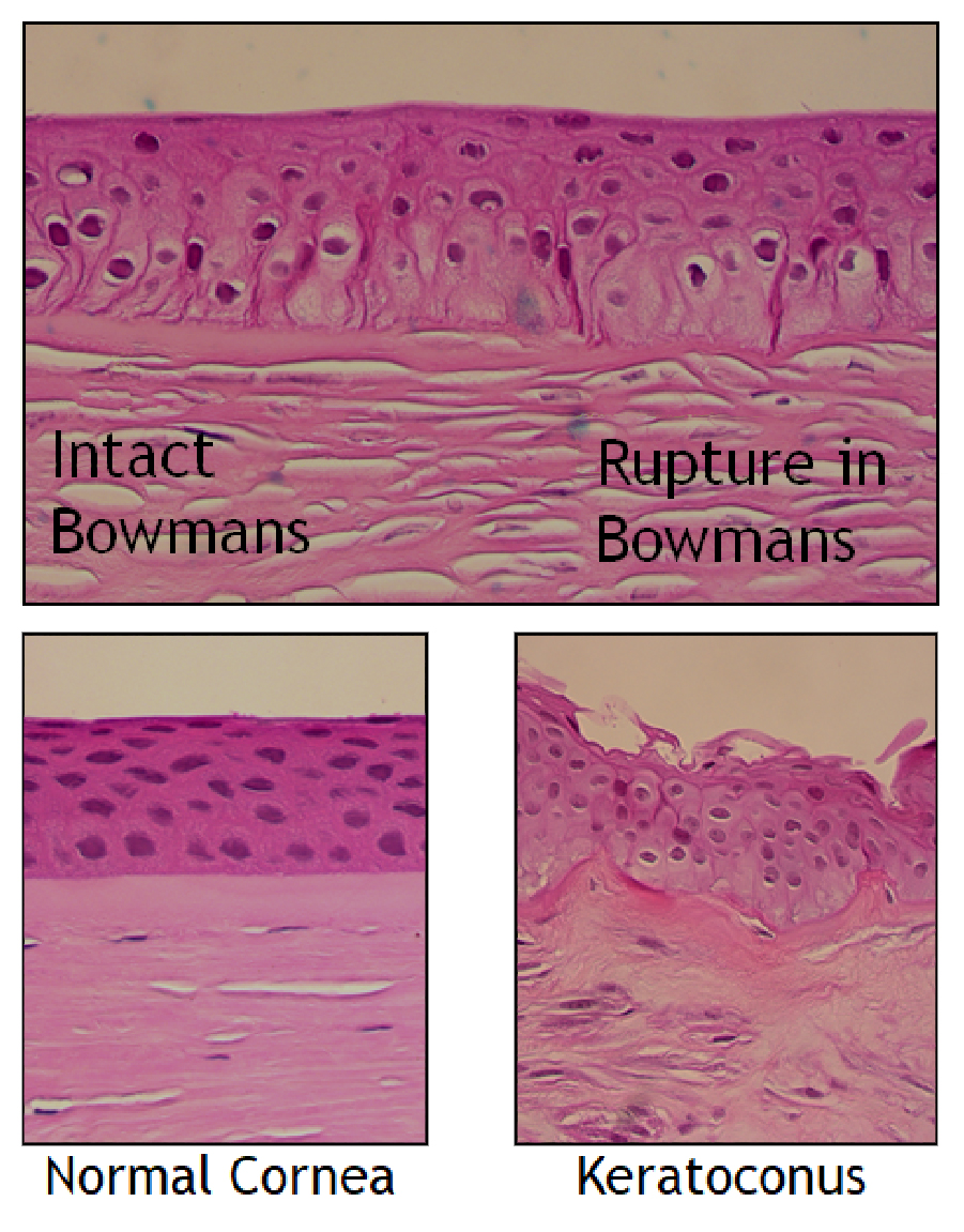 Keratoconus 101 Innocon